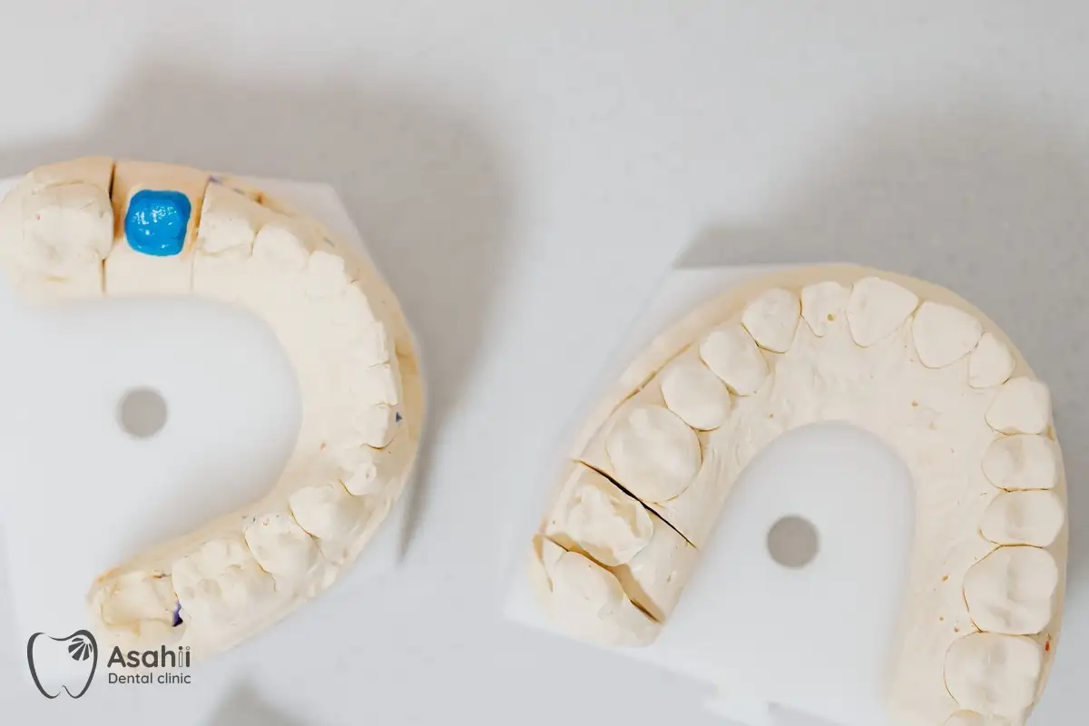 Plaster models from dental impressions, used by the lab to make crowns that fit the prepared teeth