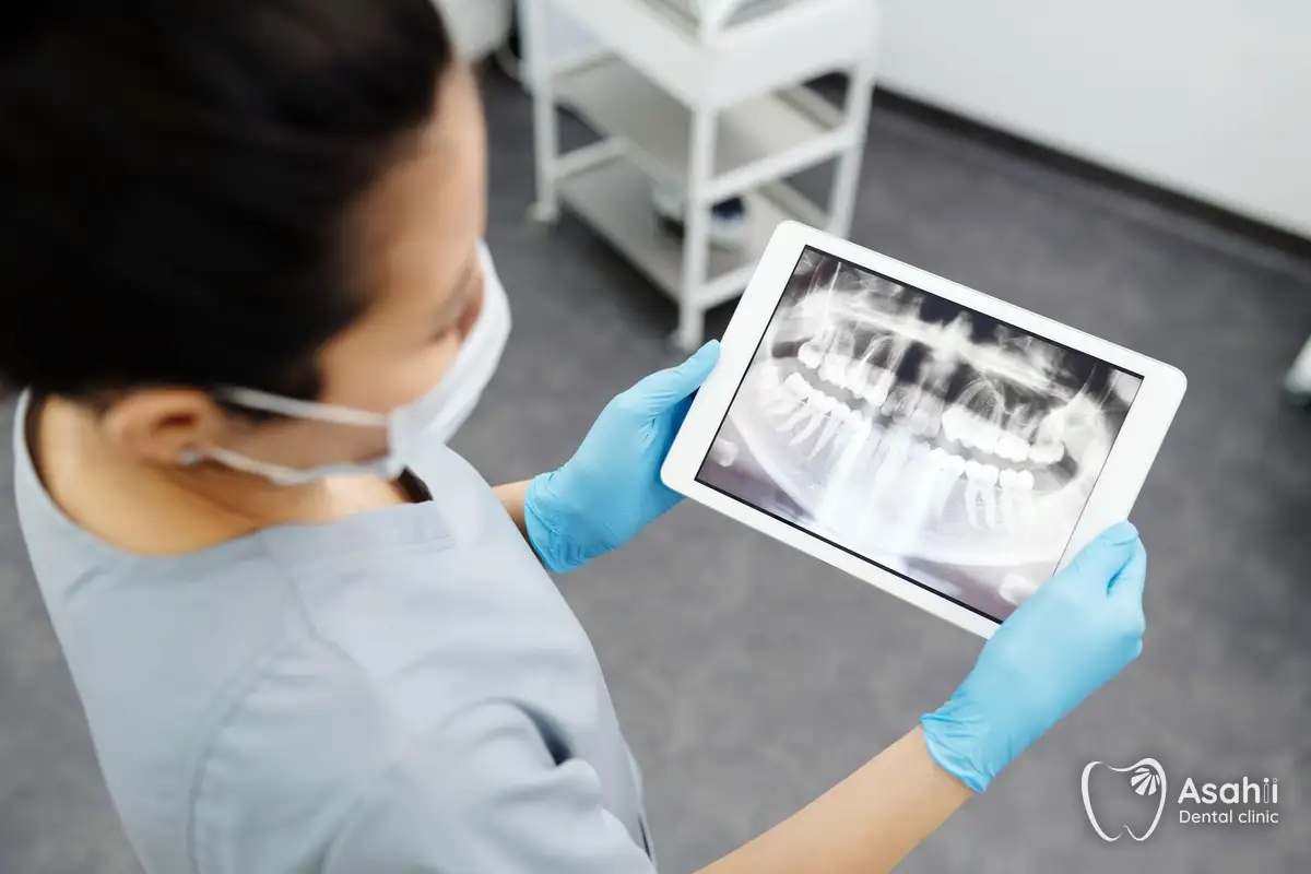 A full-mouth X-ray shows how a wisdom tooth is growing and where the nerve lies