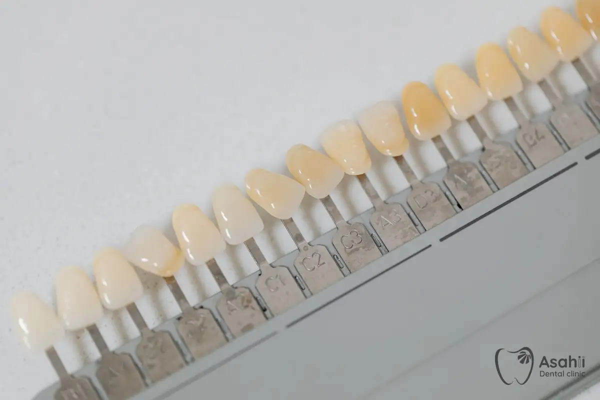 A shade guide for choosing a crown: teeth after root canal treatment often need one to avoid cracking