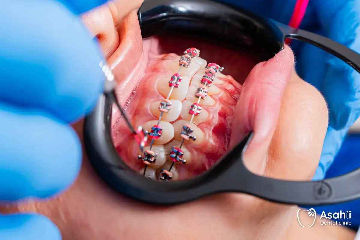 Mắc cài lỏng hay đầu dây dài cần được bác sĩ kiểm tra ở buổi hẹn gần nhất