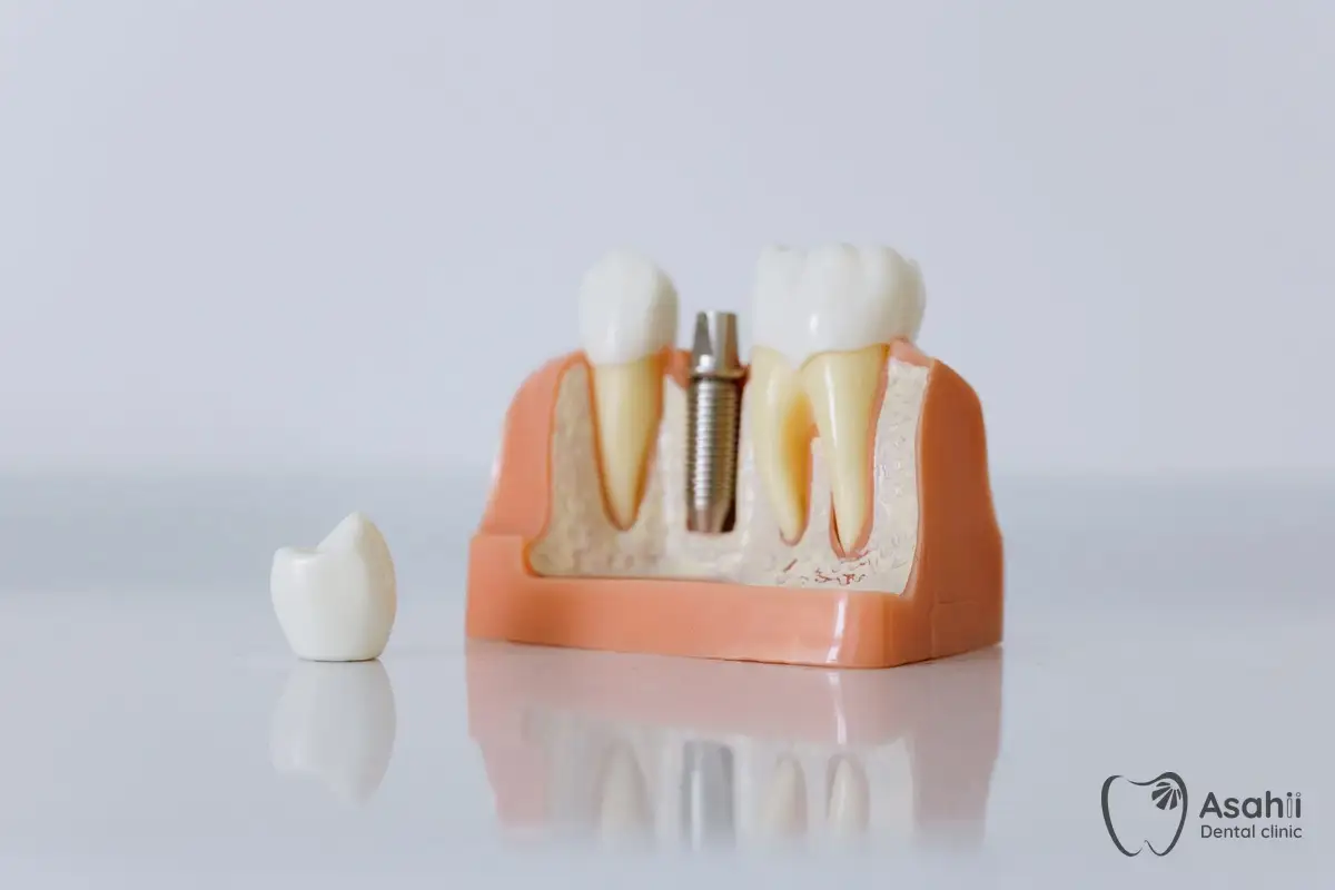 A model of an implant and crown, one of the options for replacing a missing tooth