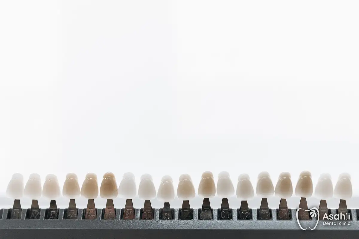 Porcelain shade samples: veneers and crowns are both colour-matched to the natural teeth